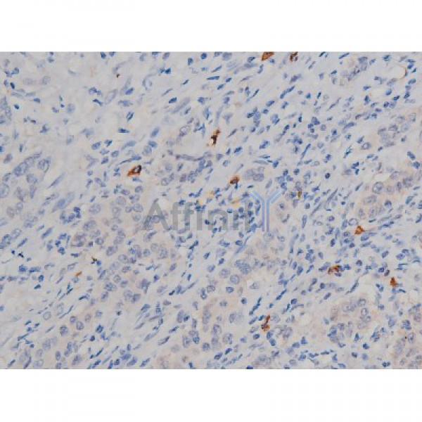 Phospho-Hsp90 beta (Ser254)[Ser255] Antibody - AF3126 at 1/200 staining Human ganstric cancer tissue sections by IHC-P.